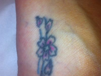 laser tattoo removal before