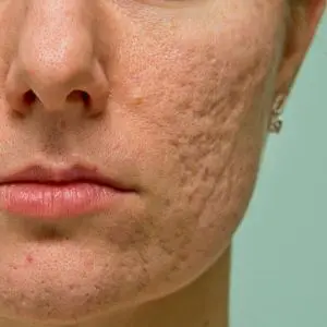 acne hormone blog sk:n clinics