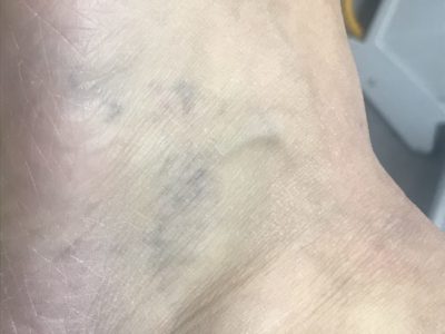 laser tattoo removal after